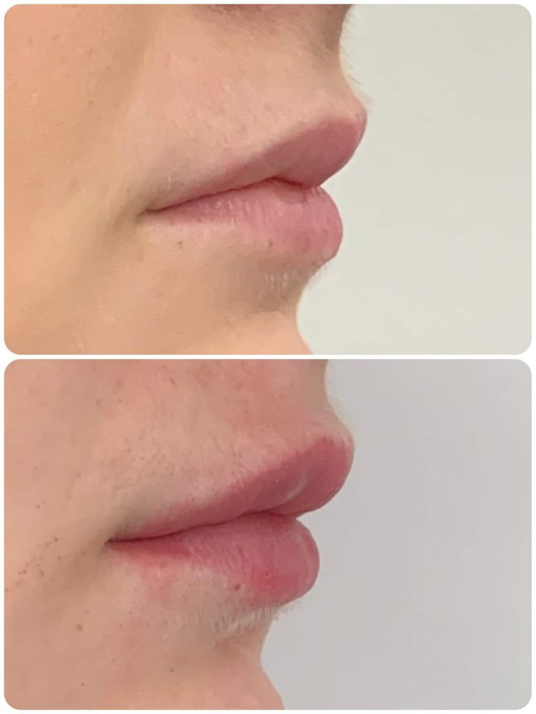 Hyaluron Pen Pro Treatment Bloemfontein